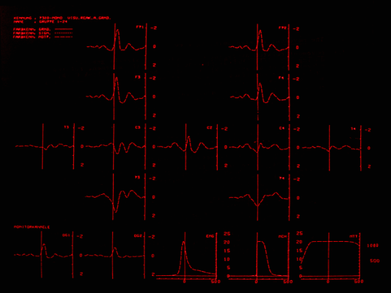 Topographie der hochspezifischen reaktionskorrelierten Motorpotentiale des Gehirns